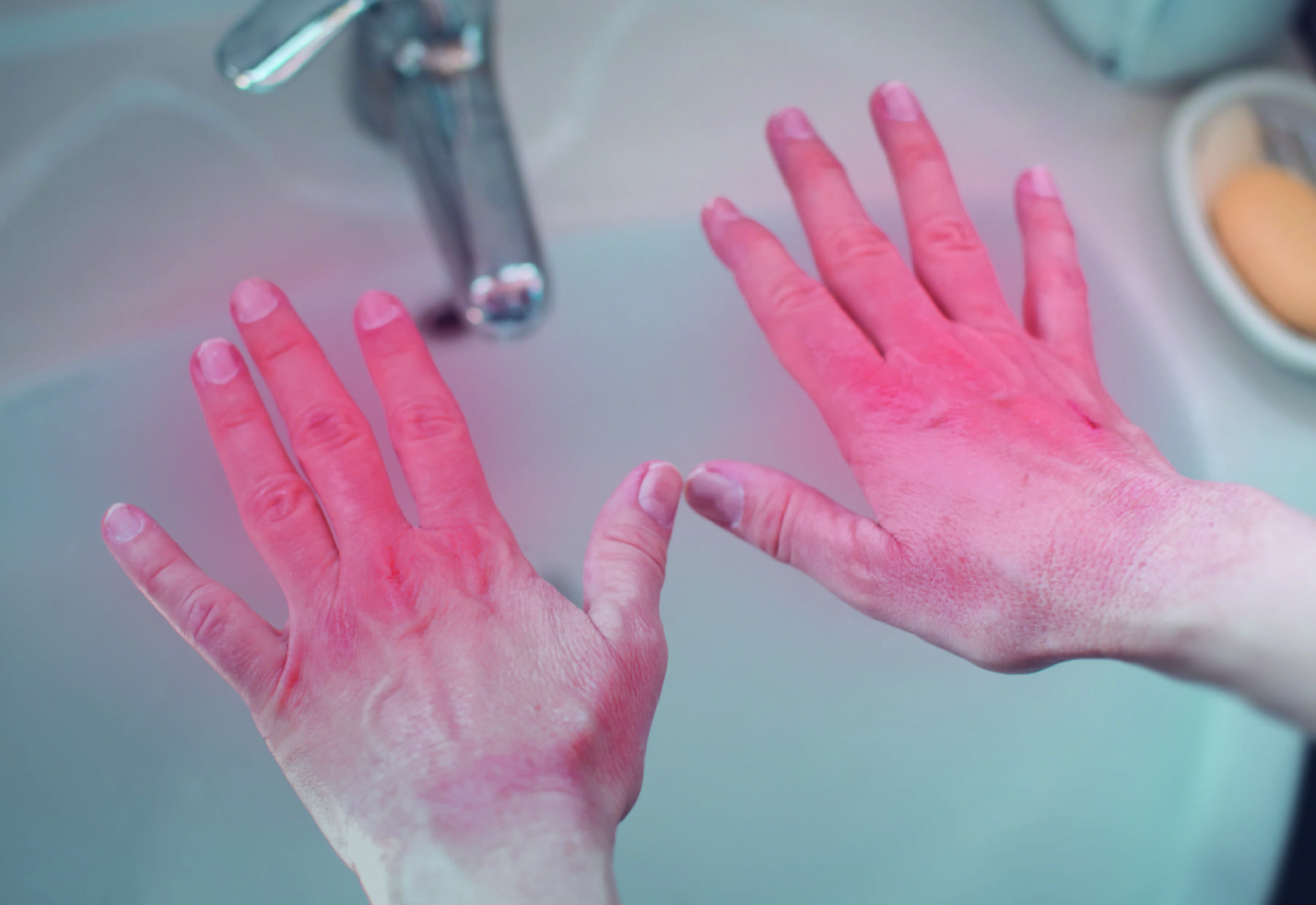 Contact Dermatitis_photo-01